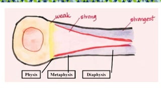1.2-Fractures in the growing skeleton.pdf