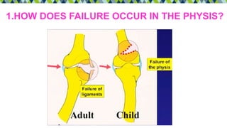 1.HOW DOES FAILURE OCCUR IN THE PHYSIS?
 