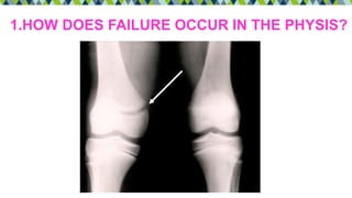 1.HOW DOES FAILURE OCCUR IN THE PHYSIS?
 