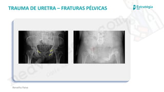 medvideos.com
Cópia não é roubo ♥
Renatha Paiva
TRAUMA DE URETRA – FRATURAS PÉLVICAS
medvideos.com
Cópia não é roubo ♥
 