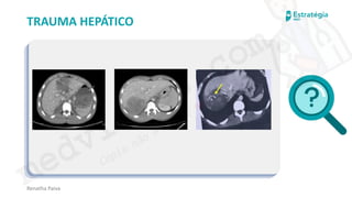 medvideos.com
Cópia não é roubo ♥
Renatha Paiva
TRAUMA HEPÁTICO
medvideos.com
Cópia não é roubo ♥
 