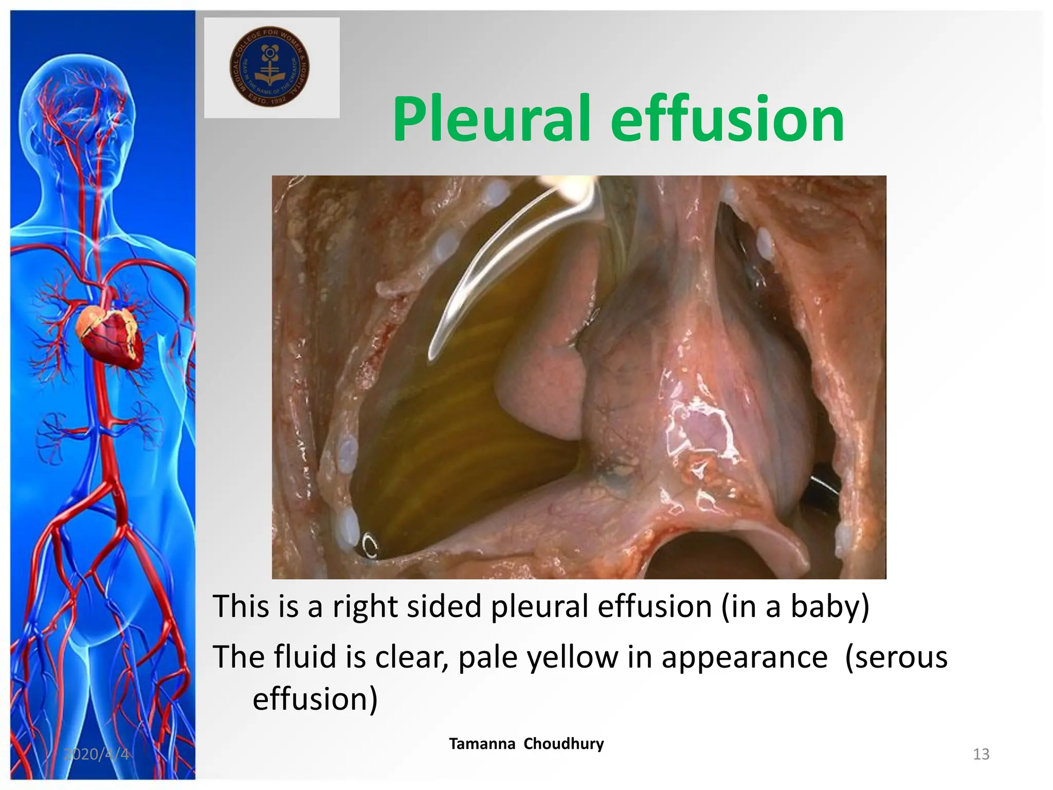 Pleural effusion
This is a right sided pleural effusion (in a baby)
The fluid is clear, pale yellow in appearance (serous
effusion)
2020/4/4
Tamanna Choudhury
13
 