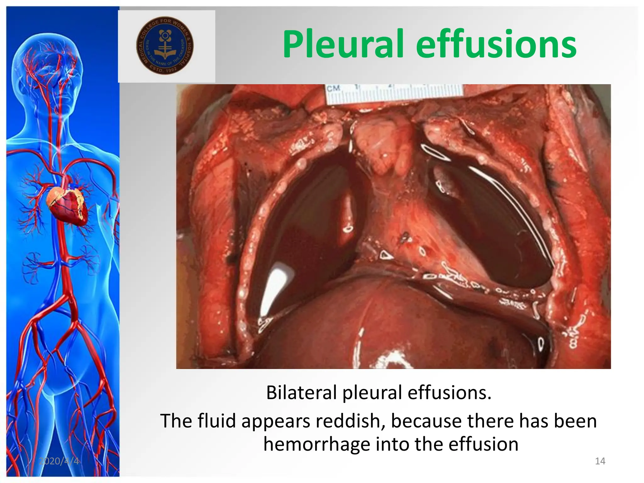 Pleural effusions
Bilateral pleural effusions.
The fluid appears reddish, because there has been
hemorrhage into the effusion
2020/4/4 14
 