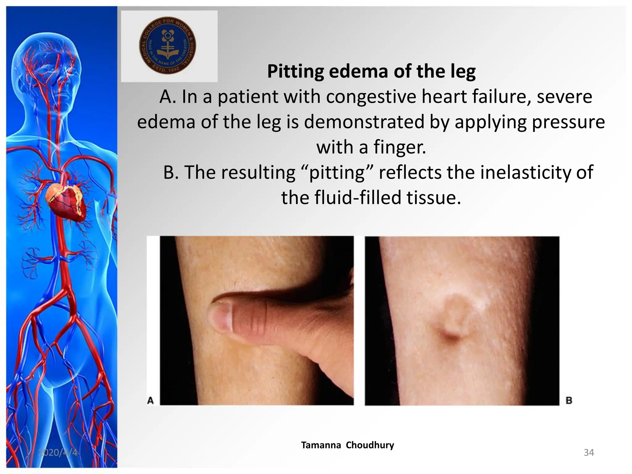Pitting edema of the leg
A. In a patient with congestive heart failure, severe
edema of the leg is demonstrated by applying pressure
with a finger.
B. The resulting “pitting” reflects the inelasticity of
the fluid-filled tissue.
2020/4/4
Tamanna Choudhury
34
 