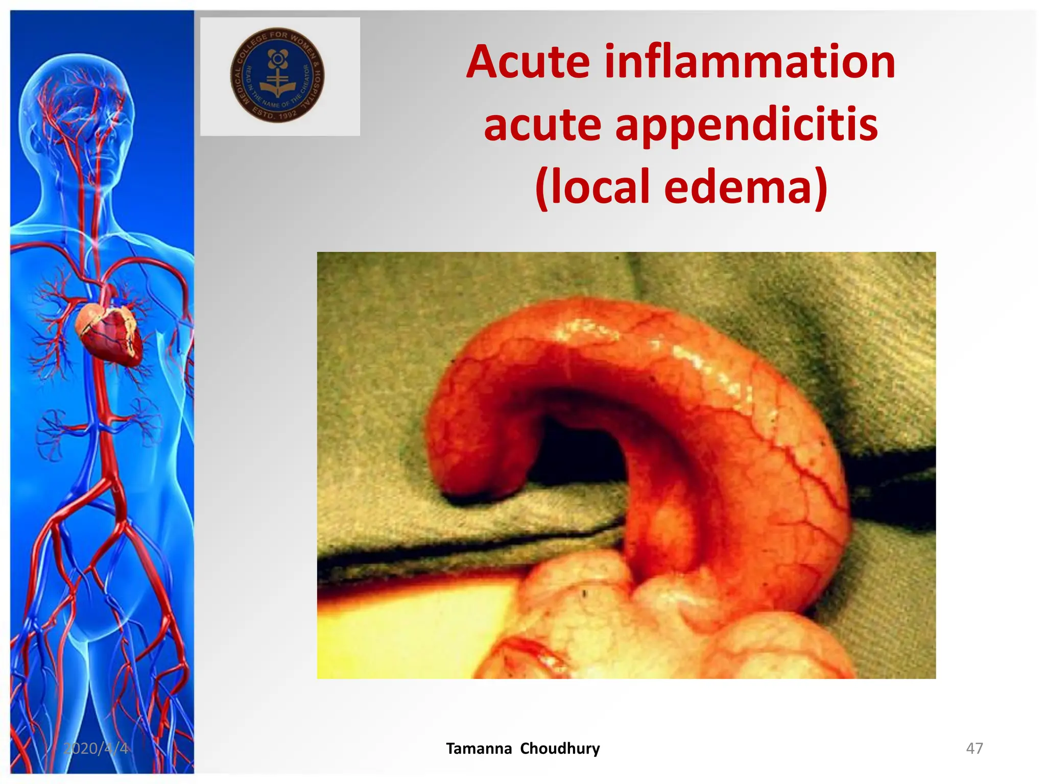 Acute inflammation
acute appendicitis
(local edema)
2020/4/4 Tamanna Choudhury 47
 