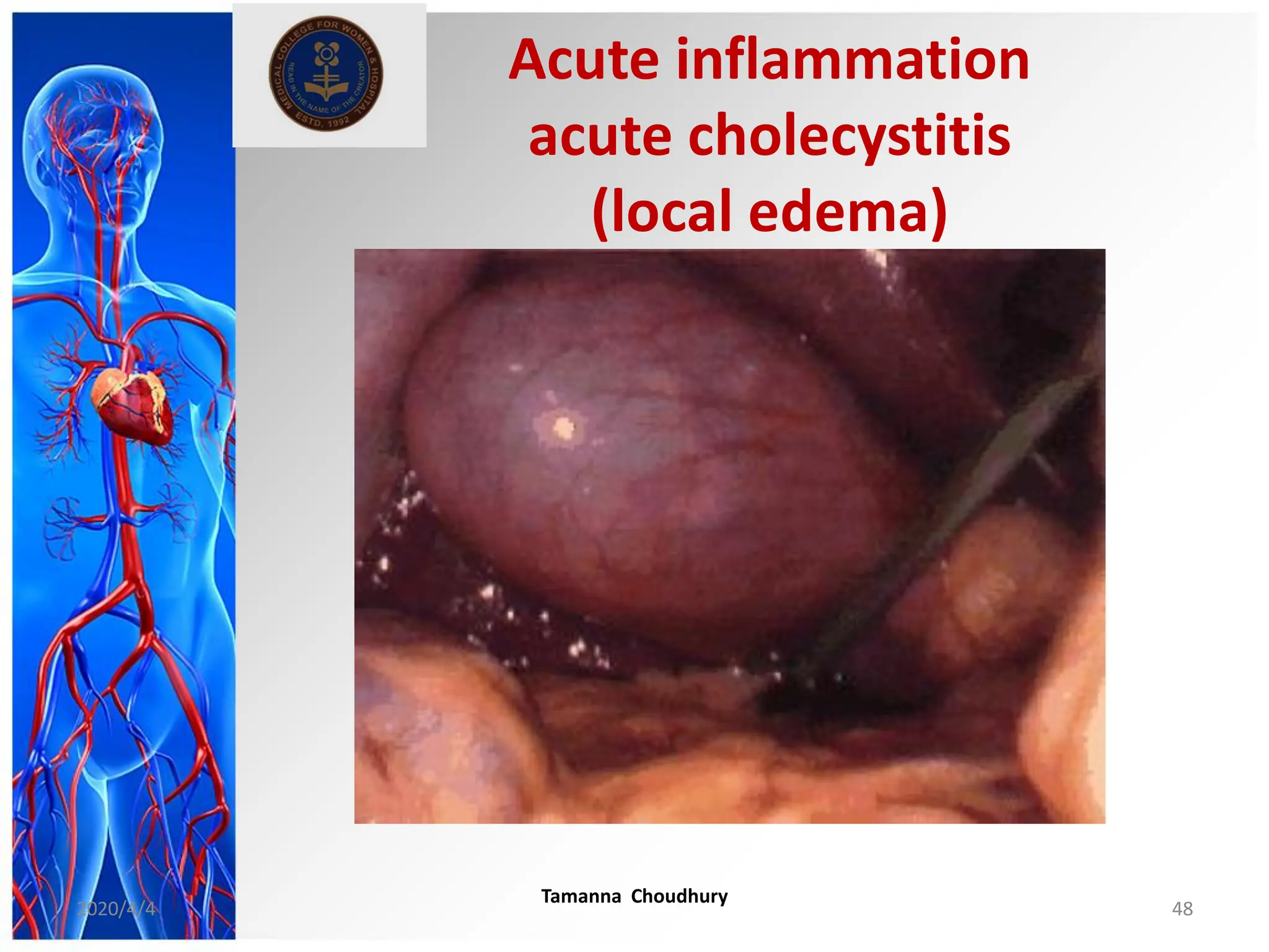 Acute inflammation
acute cholecystitis
(local edema)
2020/4/4
Tamanna Choudhury
48
 