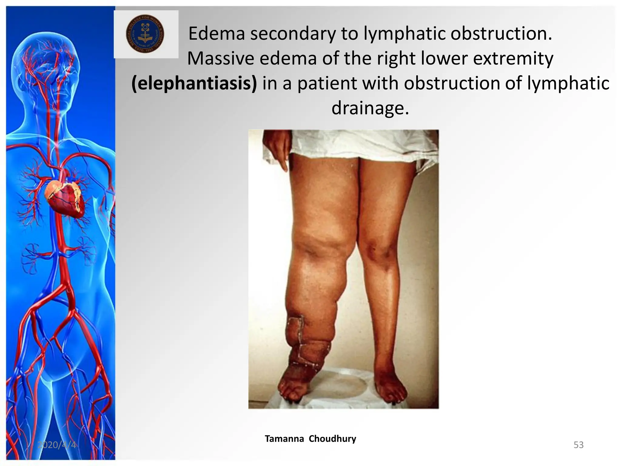Edema secondary to lymphatic obstruction.
Massive edema of the right lower extremity
(elephantiasis) in a patient with obstruction of lymphatic
drainage.
2020/4/4
Tamanna Choudhury
53
 