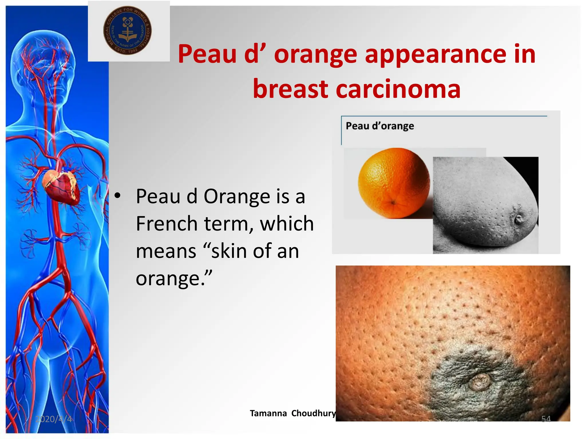 Peau d’ orange appearance in
breast carcinoma
• Peau d Orange is a
French term, which
means “skin of an
orange.”
2020/4/4
Tamanna Choudhury
54
 