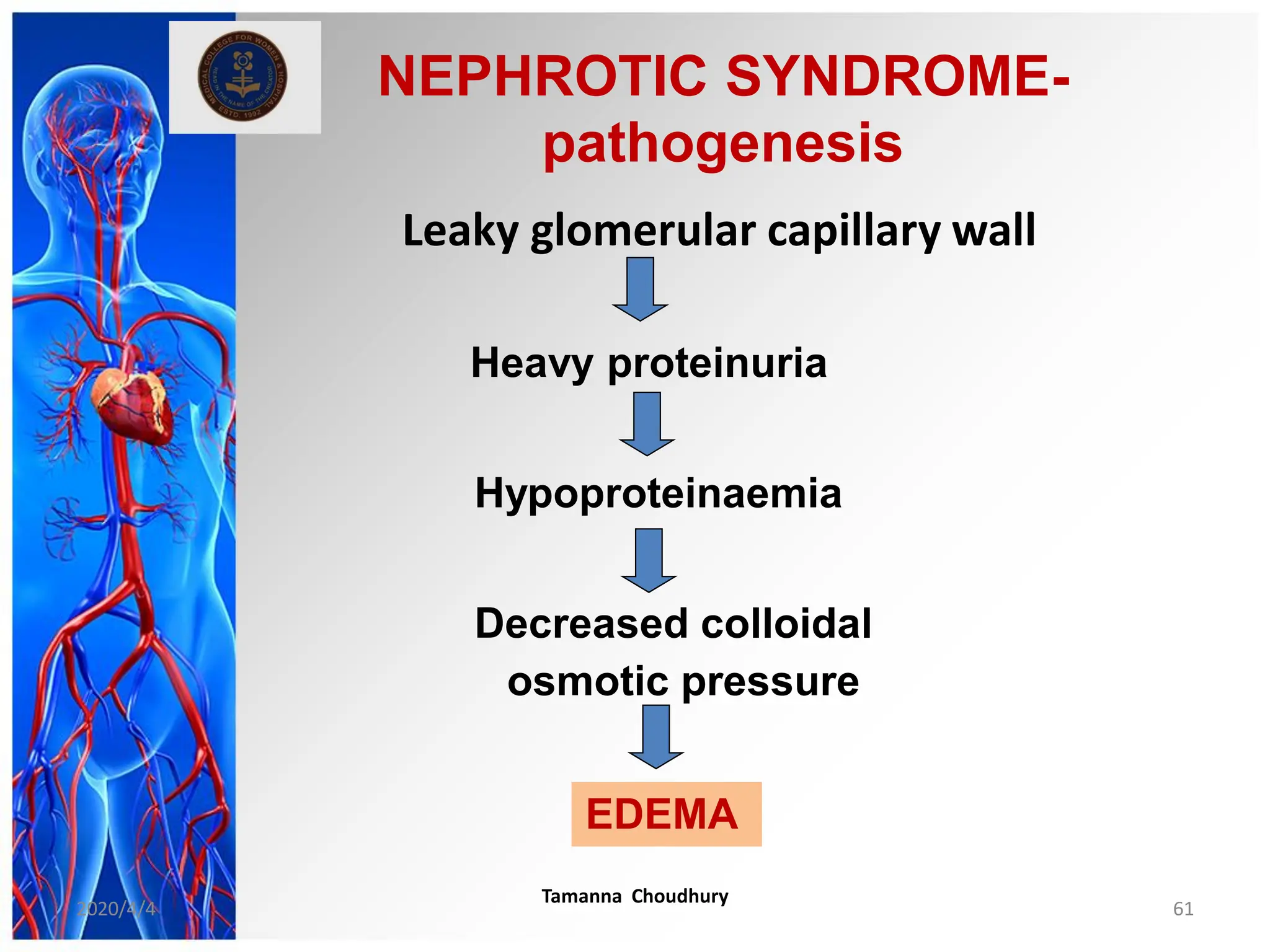 NEPHROTIC SYNDROME-
pathogenesis
Leaky glomerular capillary wall
Heavy proteinuria
Hypoproteinaemia
Decreased colloidal
osmotic pressure
EDEMA
2020/4/4
Tamanna Choudhury
61
 