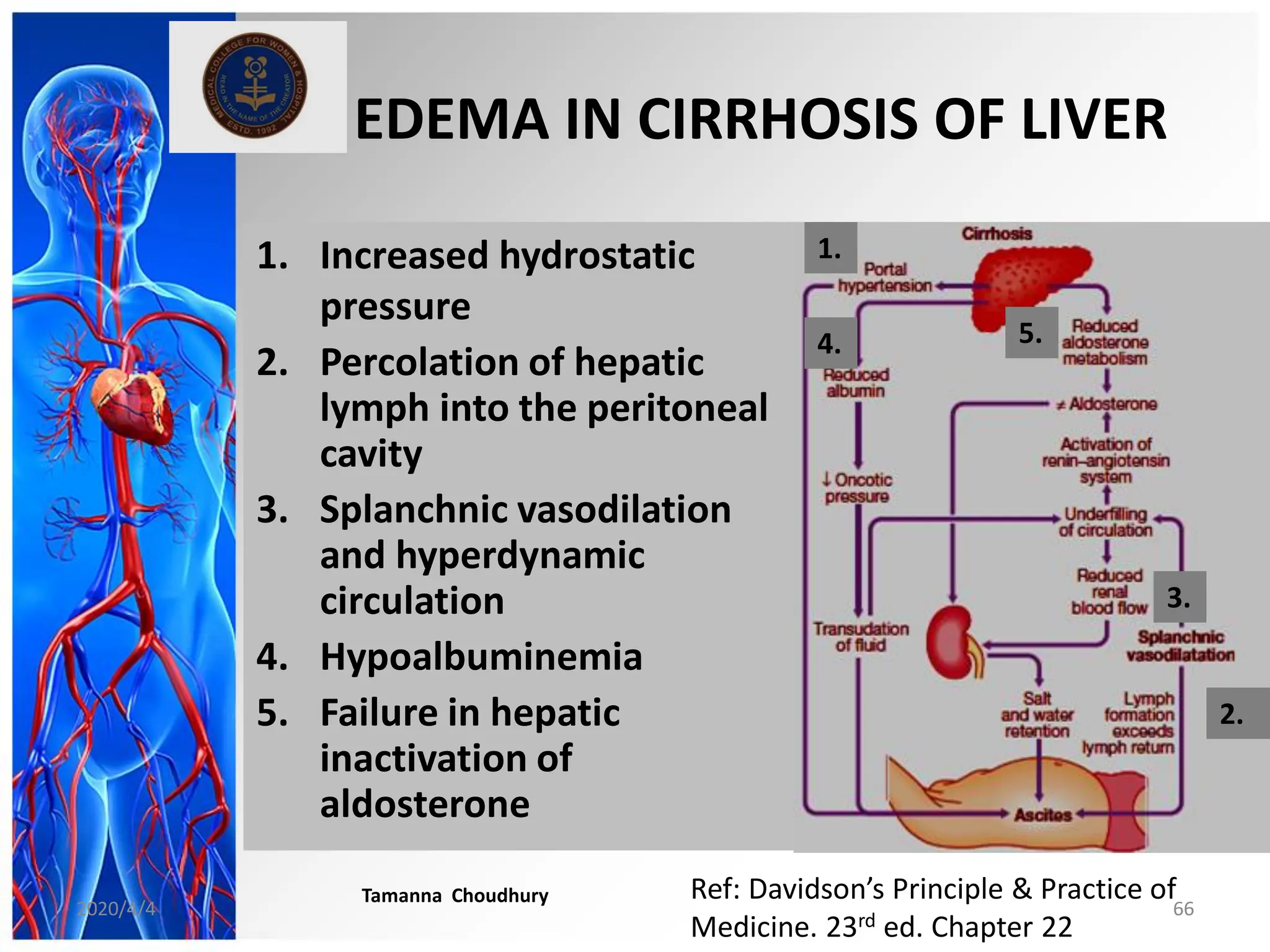 1. Increased hydrostatic
pressure
2. Percolation of hepatic
lymph into the peritoneal
cavity
3. Splanchnic vasodilation
and hyperdynamic
circulation
4. Hypoalbuminemia
5. Failure in hepatic
inactivation of
aldosterone
EDEMA IN CIRRHOSIS OF LIVER
1.
3.
4. 5.
2.
Ref: Davidson’s Principle & Practice of
Medicine. 23rd ed. Chapter 22
2020/4/4
Tamanna Choudhury
66
 