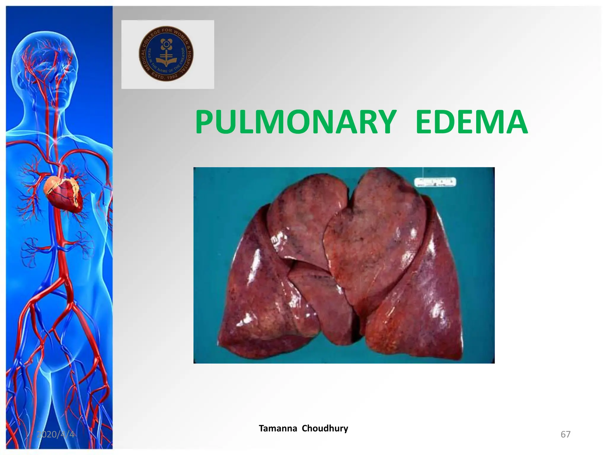 PULMONARY EDEMA
2020/4/4
Tamanna Choudhury
67
 