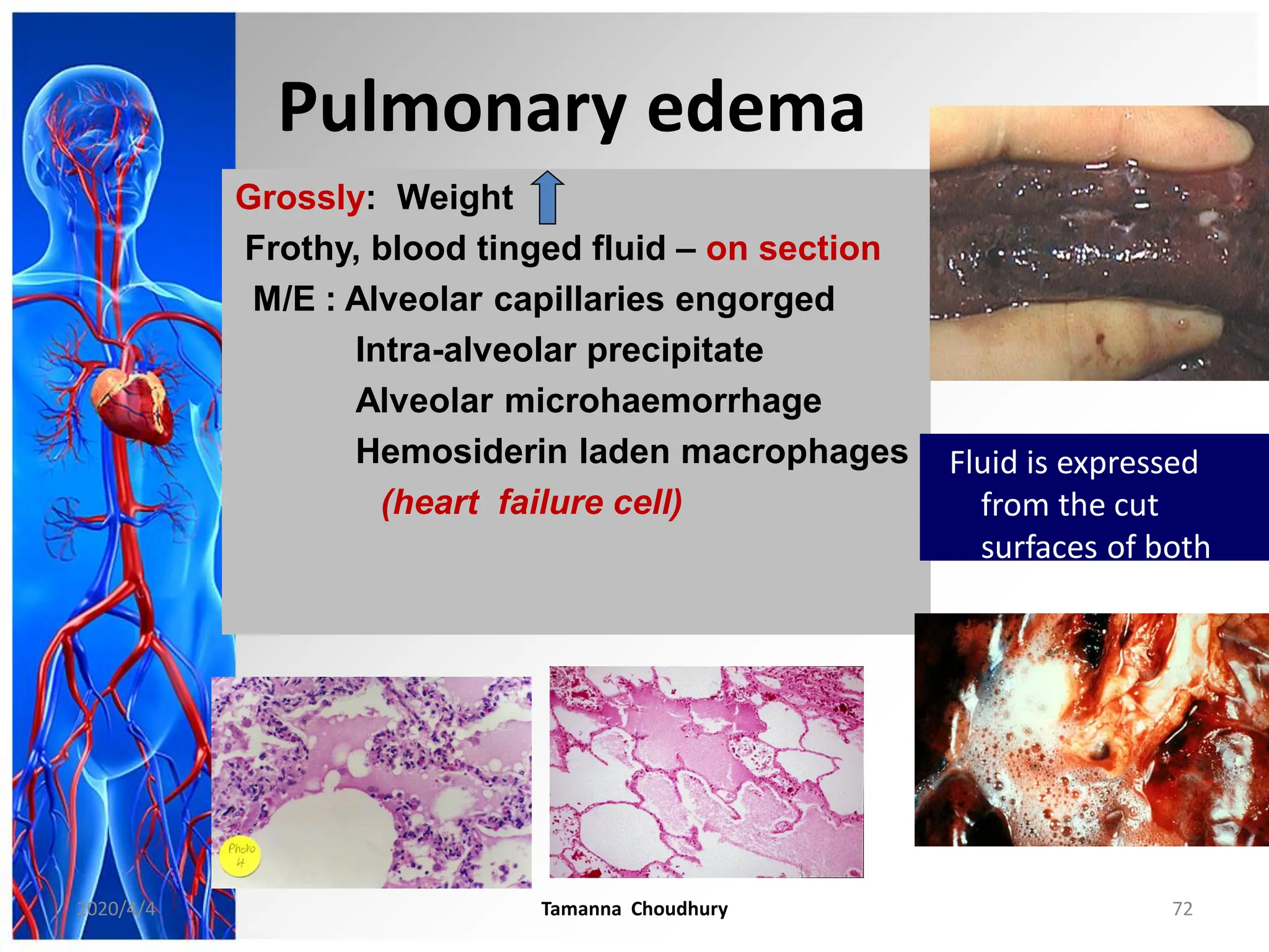Grossly: Weight
Frothy, blood tinged fluid – on section
M/E : Alveolar capillaries engorged
Intra-alveolar precipitate
Alveolar microhaemorrhage
Hemosiderin laden macrophages
(heart failure cell)
Fluid is expressed
from the cut
surfaces of both
lungs
Pulmonary edema
2020/4/4 Tamanna Choudhury 72
 