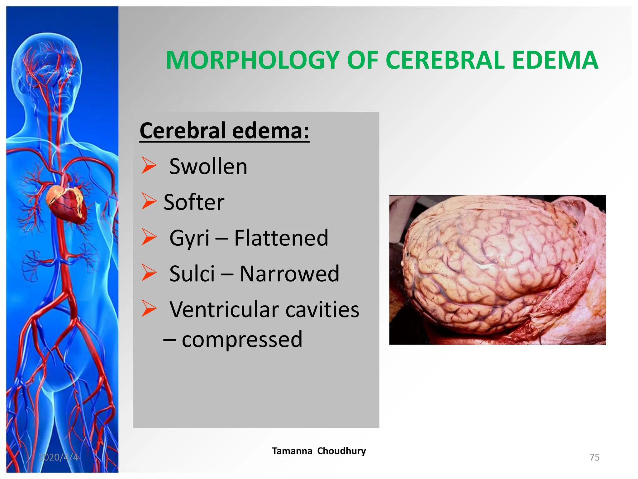 MORPHOLOGY OF CEREBRAL EDEMA
Cerebral edema:
 Swollen
 Softer
 Gyri – Flattened
 Sulci – Narrowed
 Ventricular cavities
– compressed
2020/4/4
Tamanna Choudhury
75
 