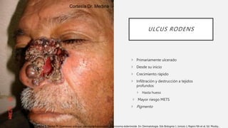 Ulcus Rodems Carcinoma basocelular, espinocelular y su tratamiento | PPTX