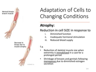 Atrophy:
Reduction in cell SIZE in response to
i. Diminished function
ii. Inadequate hormonal stimulation
iii. Reduced blood supply
E.g.
• Reduction of skeletal muscle size when
extremity is immobilized in a cast for a
prolonged period
• Shrinkage of breasts and genitals following
menopause due to diminished estrogen
secretion
123
Adaptation of Cells to
Changing Conditions
 