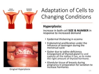 Hyperplasia:
increase in both cell SIZE & NUMBER in
response to increased demand
• Epidermal thickening in eczema
• Endometrial proliferation under the
influence of oestrogen during the
menstrual cycle
• Goiter due to iodine deficiency.
Enlargement of thyroid gland try and
capture all the iodine it can, as to make
the right amount of thyroid hormone.
• Glandular tissue of breasts during
pregnancy in preparation for lactation to
increase hormones
125
Gingival Hyperplasia
Adaptation of Cells to
Changing Conditions
 