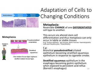 Metaplasia:
Reversible CHANGE of one DIFFERENTIATED
cell type to another.
This occurs via altered stem cell
differentiation and thus metaplasia can only
occur in labile or stable tissues
(e.g. Surface epithelia - gut mucosa, Bone marrow -haematopoietic
cells and Hepatocytes, Osteoblasts)
E.g:
Bronchial pseudostratified ciliated
epithelium becoming stratified squamous
epithelium in response to cigarette smoke.
Stratified squamous epithelium in the
esophagus becoming gastric epithelium
when exposed to persistent acid reflux
(Barrett’s esophagus) 126
Adaptation of Cells to
Changing Conditions
 