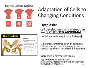 Dysplasia:
cell development and maturation
are DISTURBED & ABNORMAL
(Individual cells vary in size & shape)
E.g: chronic inflammation of epithelial
cells of uterine cervix may progress to
cervical epithelial dysplasia & neoplasia
Increased enzyme synthesis
E.g: Adaptive response as in
inactivating/detoxifying drugs or chemicals
through SER enzymes 127
Adaptation of Cells to
Changing Conditions
 