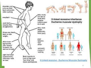 X-linked recessive inheritance
Duchenne muscular dystrophy
62
X-Linked recessive - Duchenne Muscular Dystrophy
 