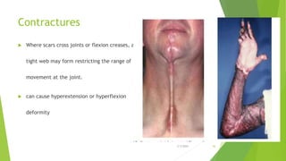 Scar Contracture Example 1.Wound healing 2.pptx.................. | PPTX