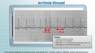 .
Chou’s Electrocardiografía en la práctica clínica. Sexta edición 2011 / Arritmias cardiacas, ITURRALDE , McGraw-Hill Interamericana
Arritmia Sinusal
Criterios
• Criterios de ritmo sinusal
• Intervalos P-P variables.
• Diferencia > 0.16 seg entre el ciclo más corto y el
más largo en una misma derivación.
1,04seg
0,64 seg
 