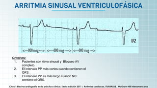 It’s the biggest planet in
the Solar System
ARRITMIA SINUSAL VENTRICULOFÁSICA
Chou’s Electrocardiografía en la práctica clínica. Sexta edición 2011 / Arritmias cardiacas, ITURRALDE , McGraw-Hill Interamericana
Criterios:
1. Pacientes con ritmo sinusal y Bloqueo AV
completo.
2. El intervalo PP más cortos cuando contienen el
QRS.
3. El intervalo PP es más largo cuando NO
contiene el QRS.
 