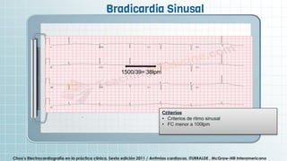 1. Ritmo sinusal y ectópicos.pptx estudio | PPTX