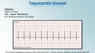 It’s the biggest planet in
the Solar System
Taquicardia Sinusal
Chou’s Electrocardiografía en la práctica clínica. Sexta edición 2011 / Arritmias cardiacas, ITURRALDE , McGraw-Hill Interamericana
Criterios:
•Ritmo sinusal
•FC: mayor 100 lat/min
•FC Sinusal máxima: 220-edad
 