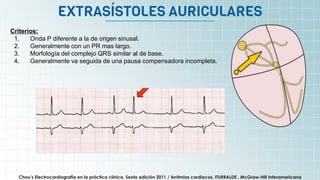 EXTRASÍSTOLES AURICULARES
Chou’s Electrocardiografía en la práctica clínica. Sexta edición 2011 / Arritmias cardiacas, ITURRALDE , McGraw-Hill Interamericana
Criterios:
1. Onda P diferente a la de origen sinusal.
2. Generalmente con un PR mas largo.
3. Morfología del complejo QRS similar al de base.
4. Generalmente va seguida de una pausa compensadora incompleta.
 
