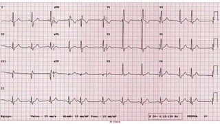 VECTORES
Chou’s Electrocardiografía en la práctica clínica. Sexta edición 2011 / Arritmias cardiacas, ITURRALDE , McGraw-Hill Interamericana
 