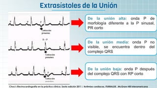 Extrasístoles de la Unión
Chou’s Electrocardiografía en la práctica clínica. Sexta edición 2011 / Arritmias cardiacas, ITURRALDE , McGraw-Hill Interamericana
De la unión alta: onda P de
morfología diferente a la P sinusal,
PR corto
De la unión media: onda P no
visible, se encuentra dentro del
complejo QRS
De la unión baja: onda P después
del complejo QRS con RP corto
 