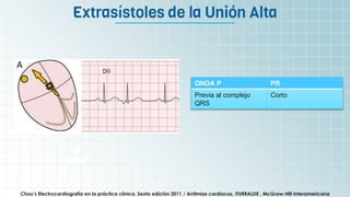 It’s the biggest planet in
the Solar System
Extrasístoles de la Unión Alta
Chou’s Electrocardiografía en la práctica clínica. Sexta edición 2011 / Arritmias cardiacas, ITURRALDE , McGraw-Hill Interamericana
ONDA P PR
Previa al complejo
QRS
Corto
 