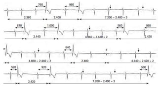 It’s the biggest planet in
the Solar System
PARASÍSTOLE
Chou’s Electrocardiografía en la práctica clínica. Sexta edición 2011 / Arritmias cardiacas, ITURRALDE , McGraw-Hill Interamericana
 