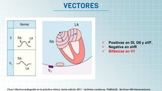 It’s the biggest planet in
the Solar System
VECTORES
Chou’s Electrocardiografía en la práctica clínica. Sexta edición 2011 / Arritmias cardiacas, ITURRALDE , McGraw-Hill Interamericana
 Positivas en DI, DII y aVF.
 Negativa en aVR
 Bifásicas en V1
 