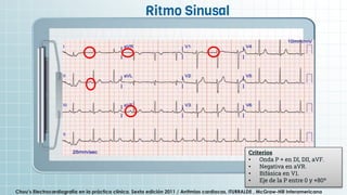 .
Criterios
• Onda P + en DI, DII, aVF.
• Negativa en aVR.
• Bifásica en V1.
• Eje de la P entre 0 y +80º
Chou’s Electrocardiografía en la práctica clínica. Sexta edición 2011 / Arritmias cardiacas, ITURRALDE , McGraw-Hill Interamericana
Ritmo Sinusal
 