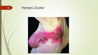 Herpes Zoster
63
 