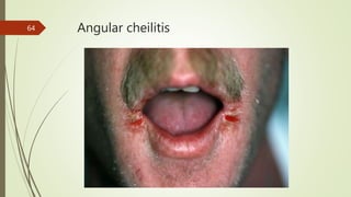 Angular cheilitis
64
 