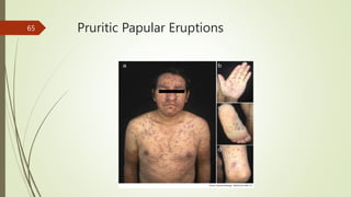 Pruritic Papular Eruptions
65
 