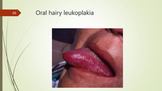 Oral hairy leukoplakia
66
 