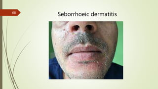 Seborrhoeic dermatitis
68
 