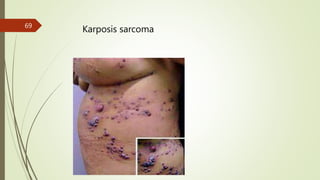 Karposis sarcoma
69
 