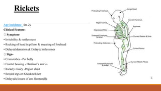 Head In Rickets Overalll Social and health education.pdf