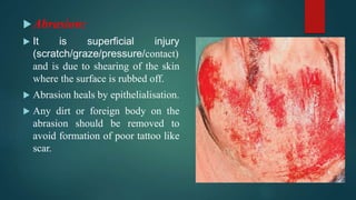 Injuries Stratch 1. WOUND & WOUND HEALING III BHMS SURGERY.ppsx