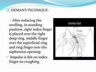  ZIEMAN’S TECHNIQUE:
- After reducing the
swelling, in standing
position, right index finger
is placed over the right
deep ring, middle finger
over the superficial ring
and ring finger over the
saphenous opening:
 Impulse is felt on index
finger on coughing
 