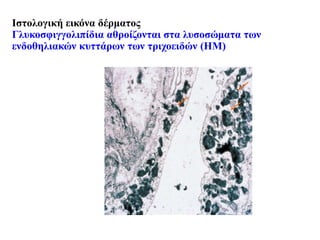 Ιστολογική εικόνα δέρματος
Γλυκοσφιγγολιπίδια αθροίζονται στα λυσοσώματα των
ενδοθηλιακών κυττάρων των τριχοειδών (HM)
 