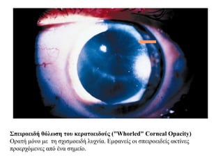 Σπειροειδή θόλωση του κερατοειδούς ("Whorled" Corneal Opacity)
Ορατή μόνο με τη σχισμοειδή λυχνία. Εμφανείς οι σπειροειδείς ακτίνες
προερχόμενες από ένα σημείο.
 