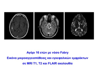 Αγόρι 16 ετών με νόσο Fabry
Εικόνα μικροαγγειοπάθειας και εγκεφαλικών εμφράκτων
σε MRI T1, T2 και FLAIR ακολουθία
 