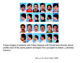 Ries et al, Genet Med 2006
Facial images of patients with Fabry disease with frontal face directly above
profile view of the same patient arranged from youngest to oldest. χ denotes
cousins.
 