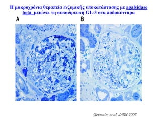 H μακροχρόνια θεραπεία ενζυμικής υποκατάστασης με agalsidase
beta μειώνει τη συσσώρευση GL-3 στα ποδοκύτταρα
Germain, et al, JASN 2007
 