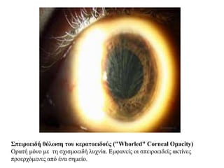 Σπειροειδή θόλωση του κερατοειδούς ("Whorled" Corneal Opacity)
Ορατή μόνο με τη σχισμοειδή λυχνία. Εμφανείς οι σπειροειδείς ακτίνες
προερχόμενες από ένα σημείο.
 